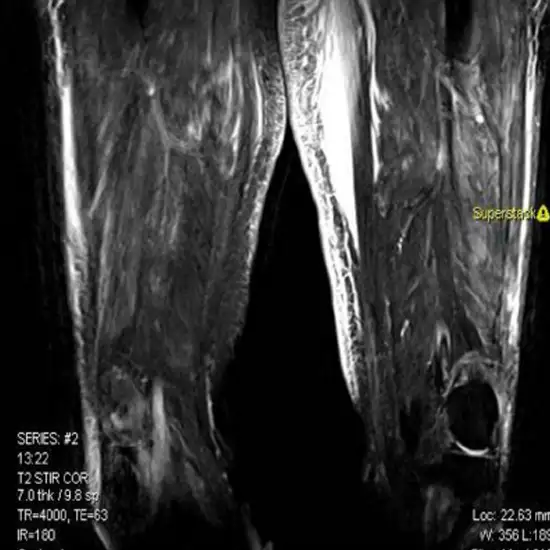 MRI Left Thigh With Contrast